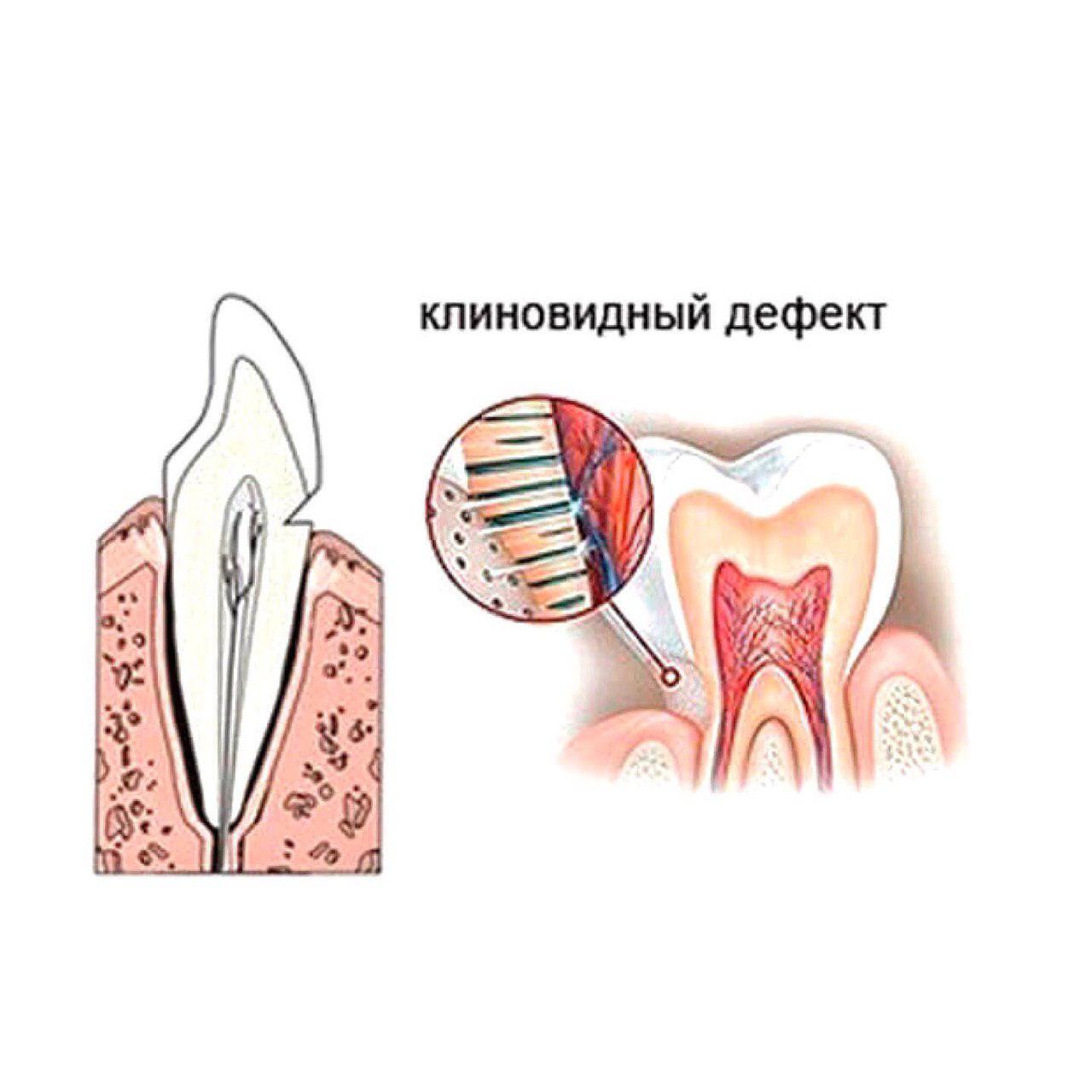 Клиновидный дефект стоматологическая карта
