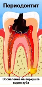 Периодонтит зуба — симптомы, виды, причины возникновения | Как лечить периодонтит?